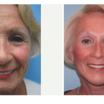 facelift female before and after image