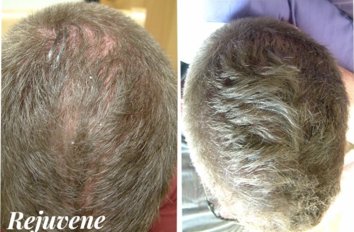 PRP Hair Regeneration Therapy - Rejuvene Plastic Surgery