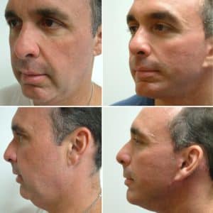 facelift male before and after image