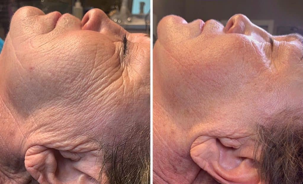 Microneedling before and after