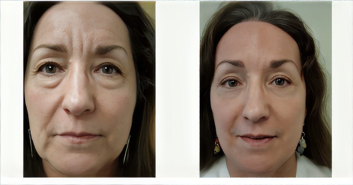 Brow-Lift-