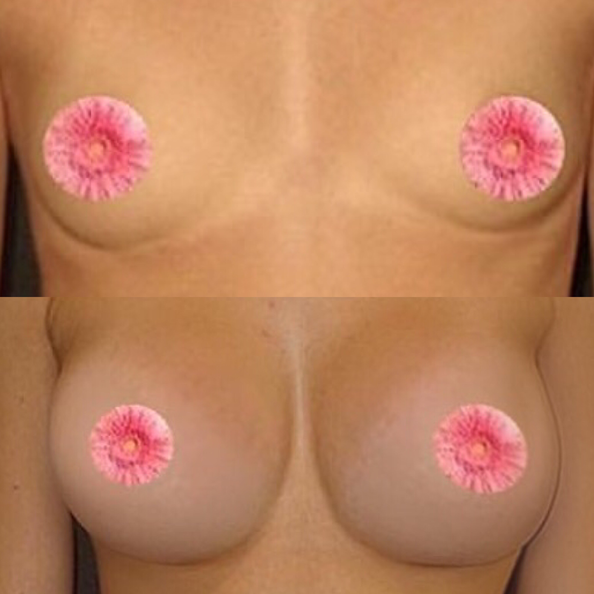 Before and After Image: Breast Augmentation - front