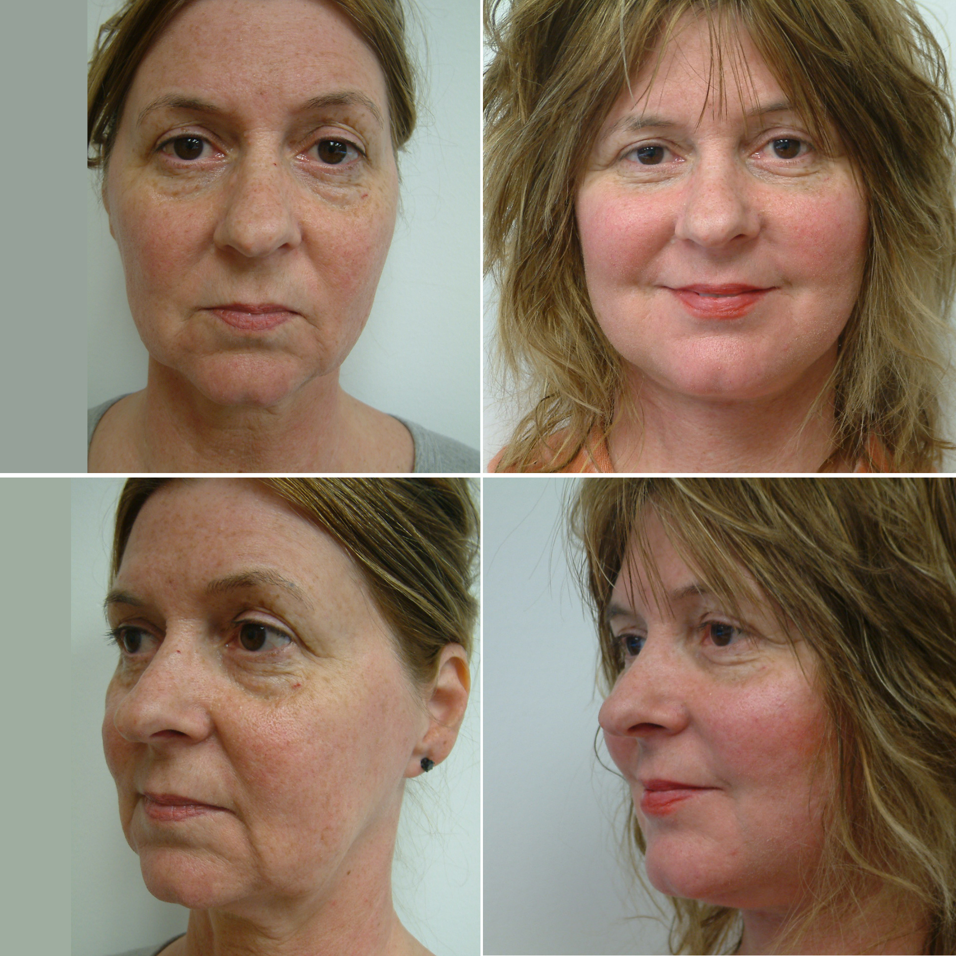 Before and After Image: Face Rejuvenation - front