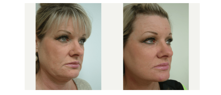 Before and After Image: Facelift and Neck Lift - right-front-oblique