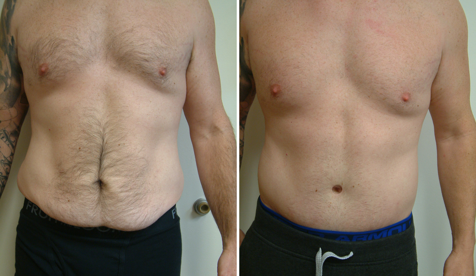 Before and After Image: Male Tummy Tuck - front