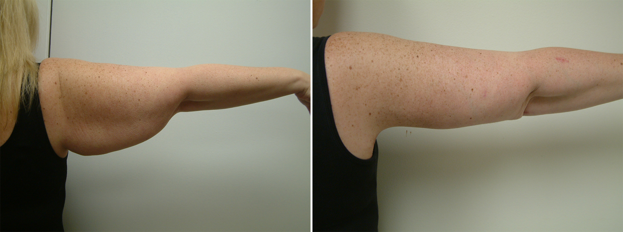 Before and After Image: Arm Lift - back