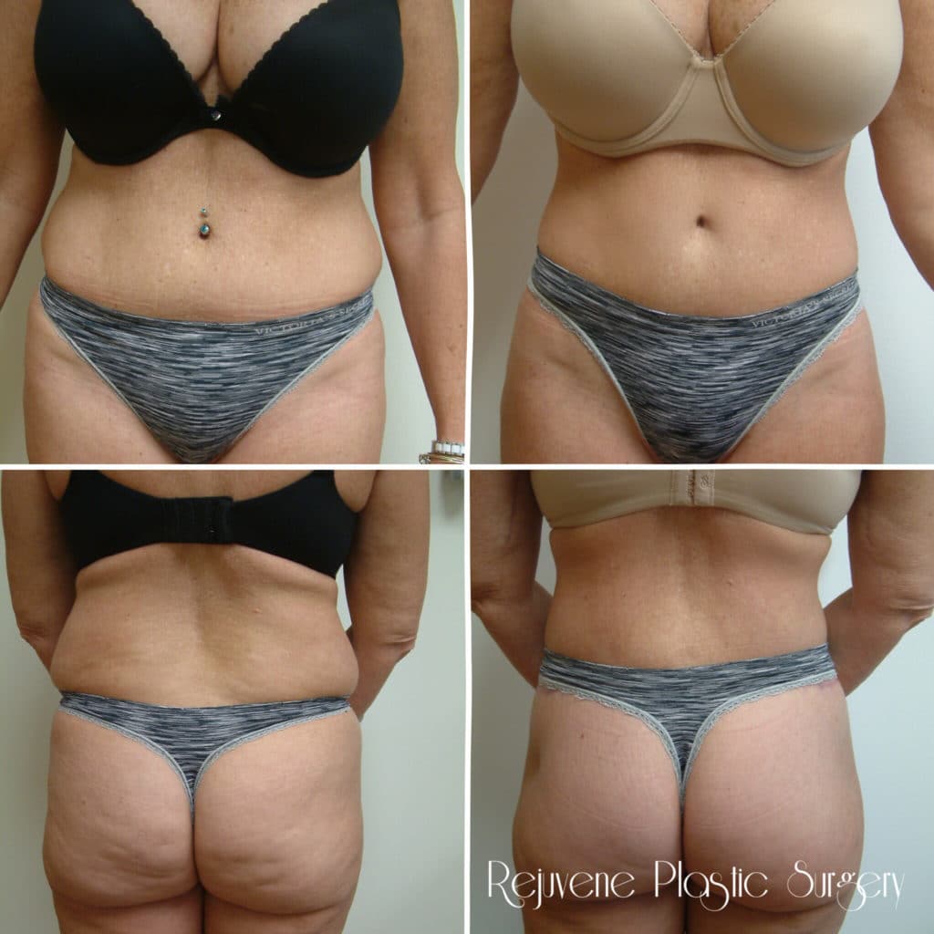 body lift and butt lift