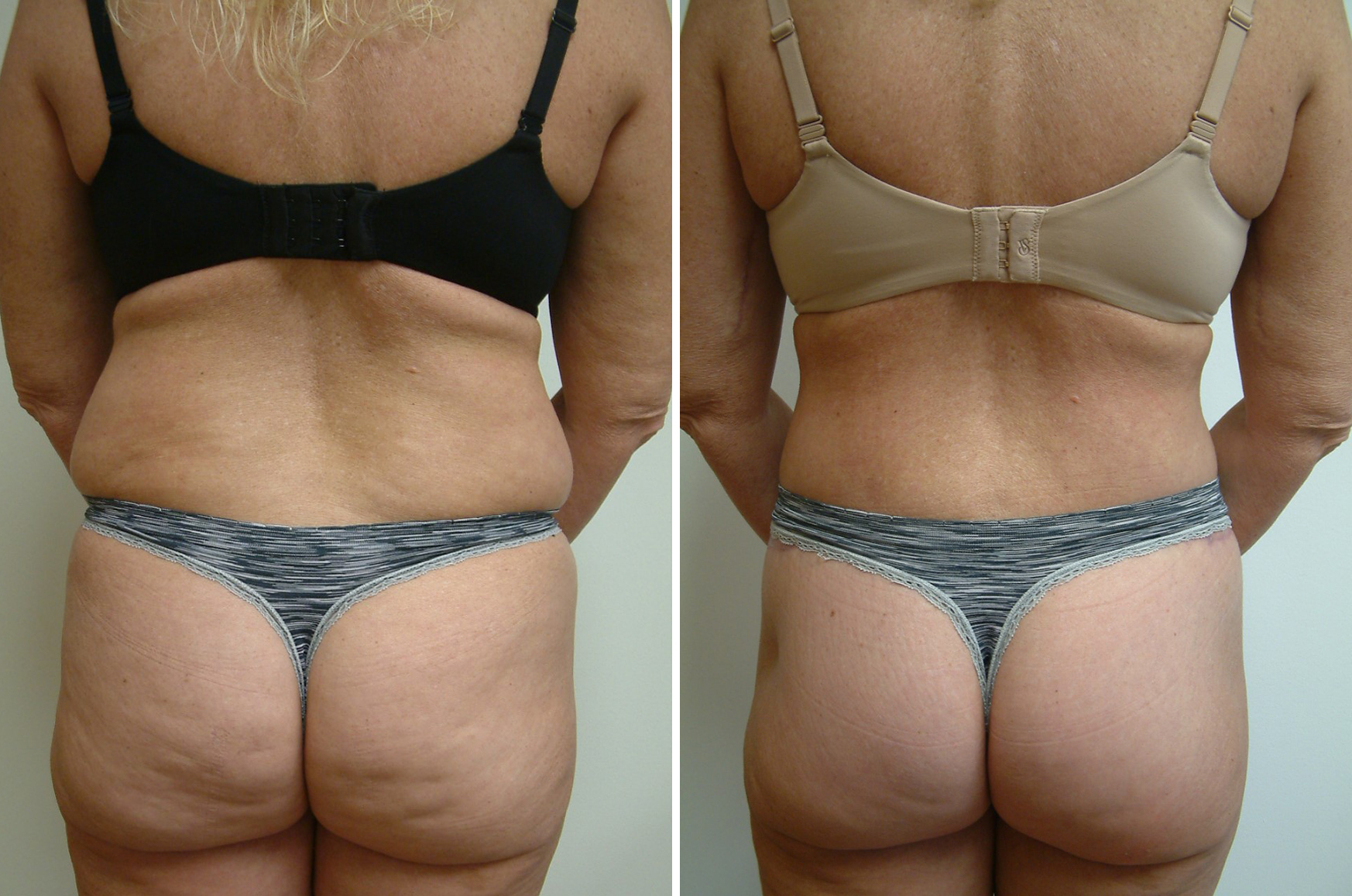 Before and After Image: Body Lift - back