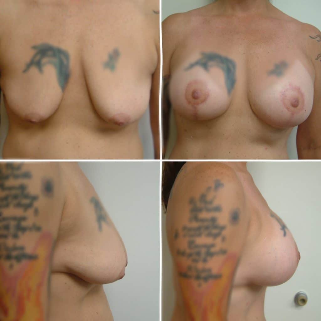 Before and After Image: Breast Lift with Implant - front