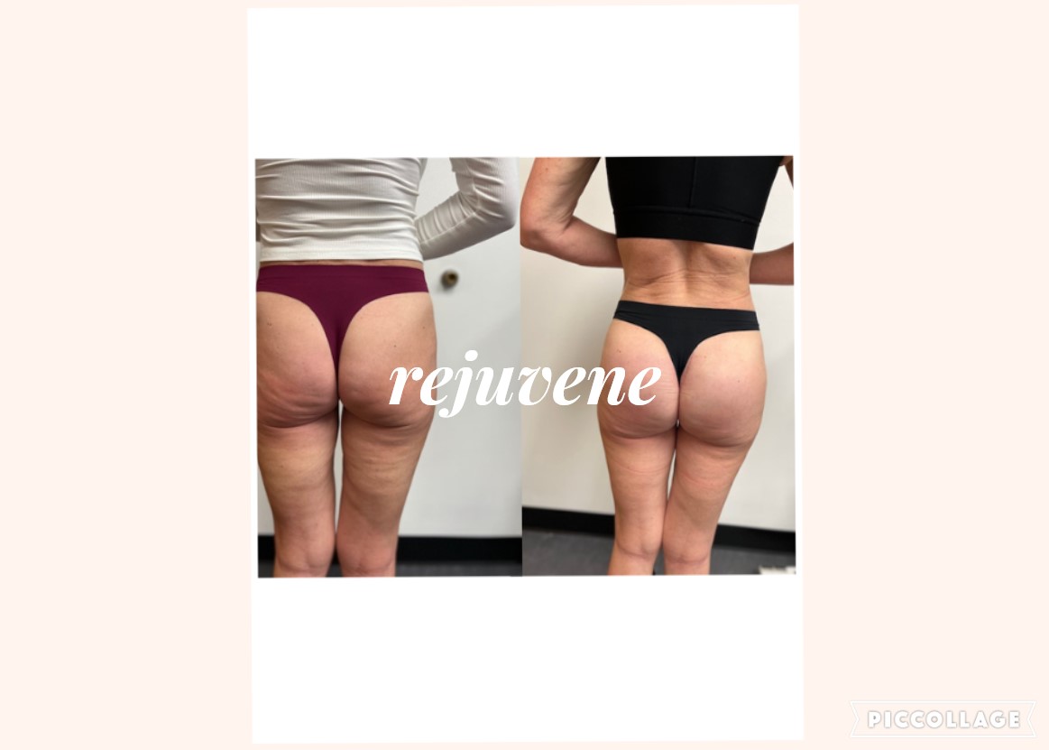 Before and After Image: Butt Implant - back