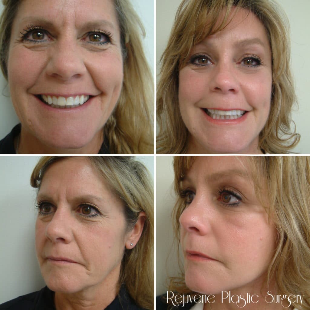 Before and After Image: Facelift and Neck Lift - front