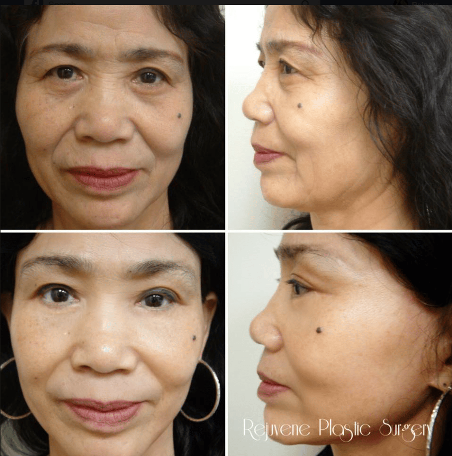 Before and After Image: Facelift and Neck Lift - front