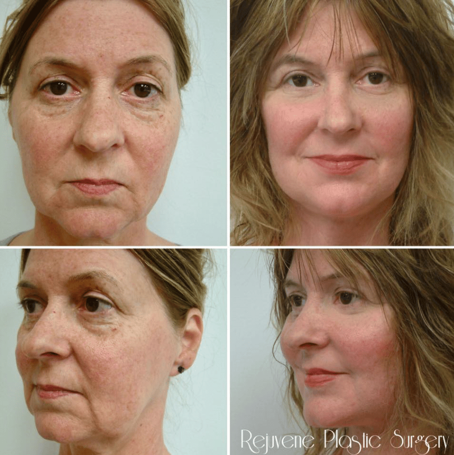 Before and After Image: Facelift and Neck Lift - front