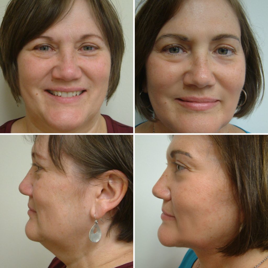 Before and After Image: Facelift and Neck Lift - front