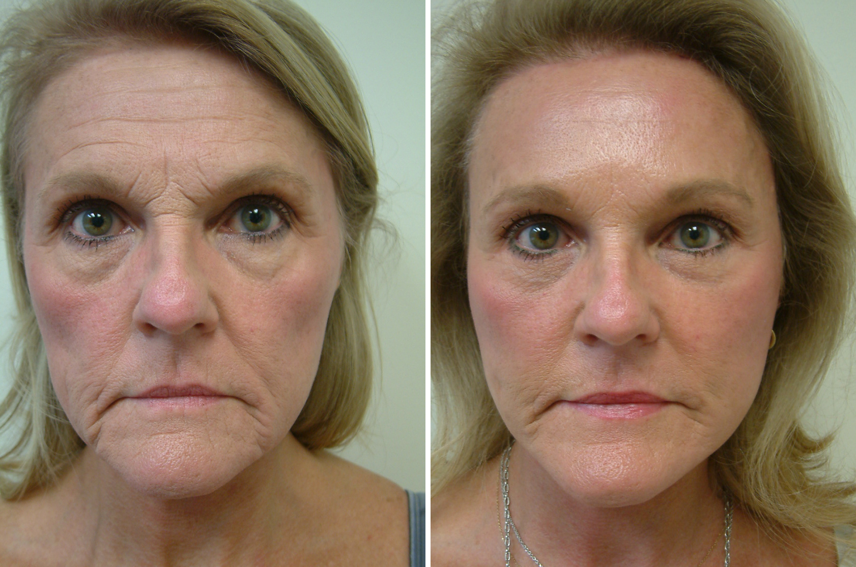 Before and After Image: Facelift - front