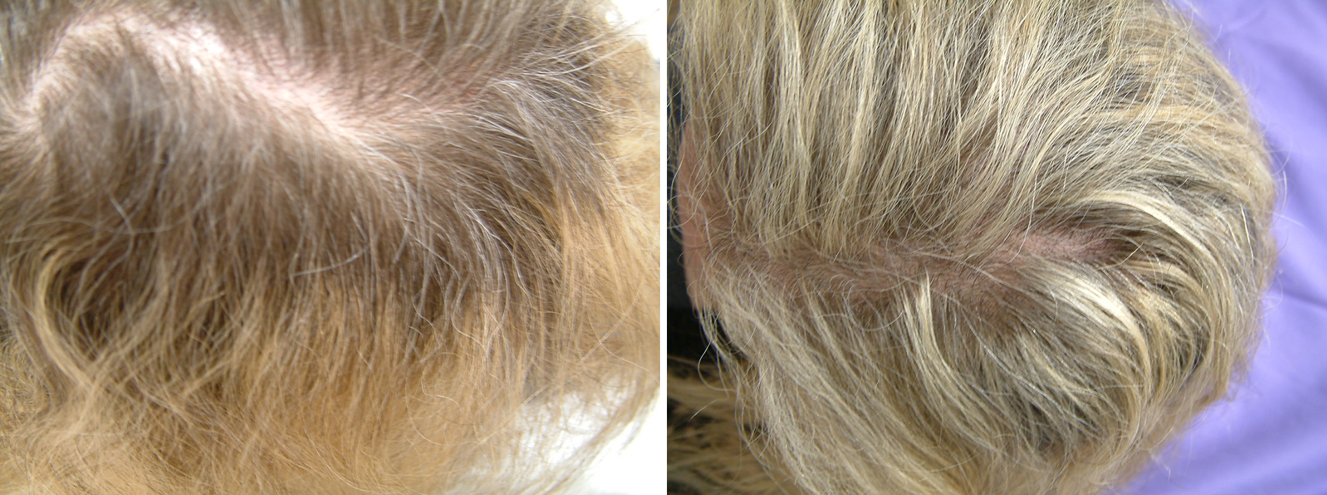Before and After Image: Hair Rejuvenation - right-side