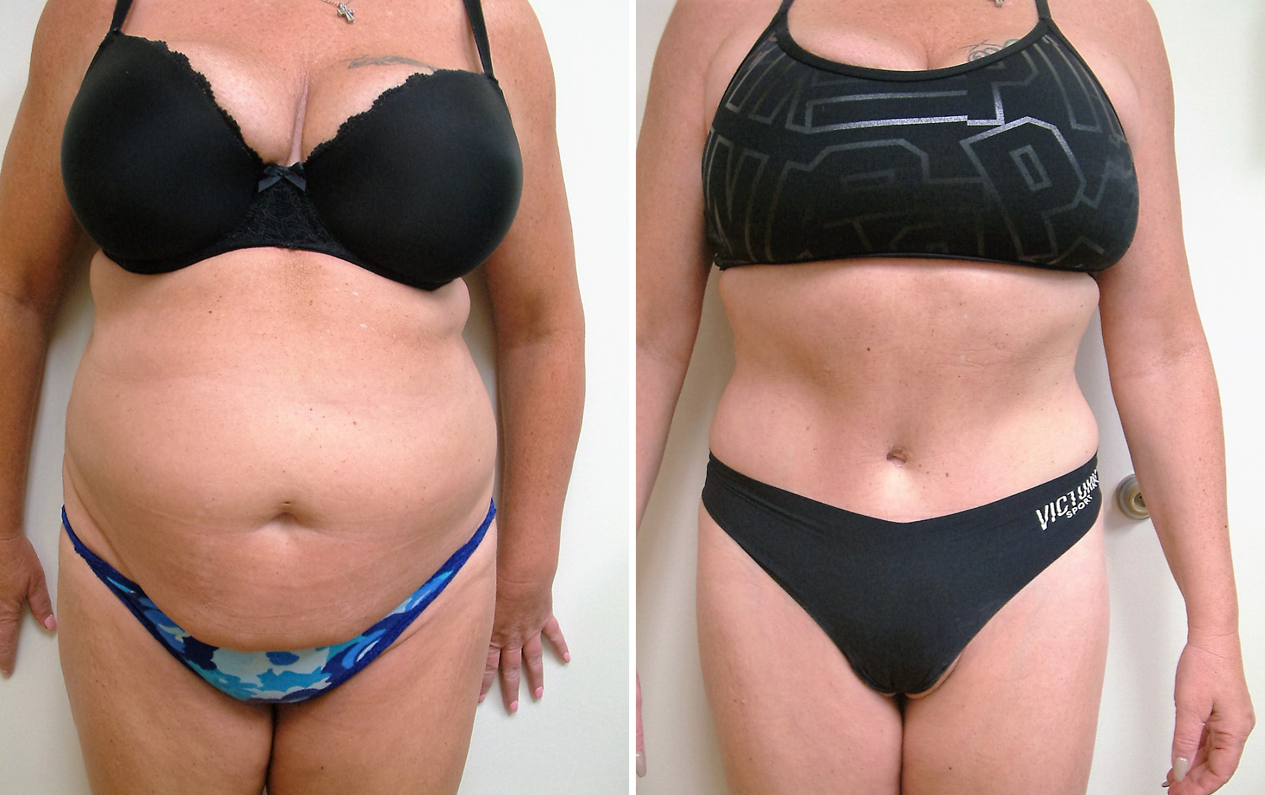 Before and After Image: Tummy Tuck - front