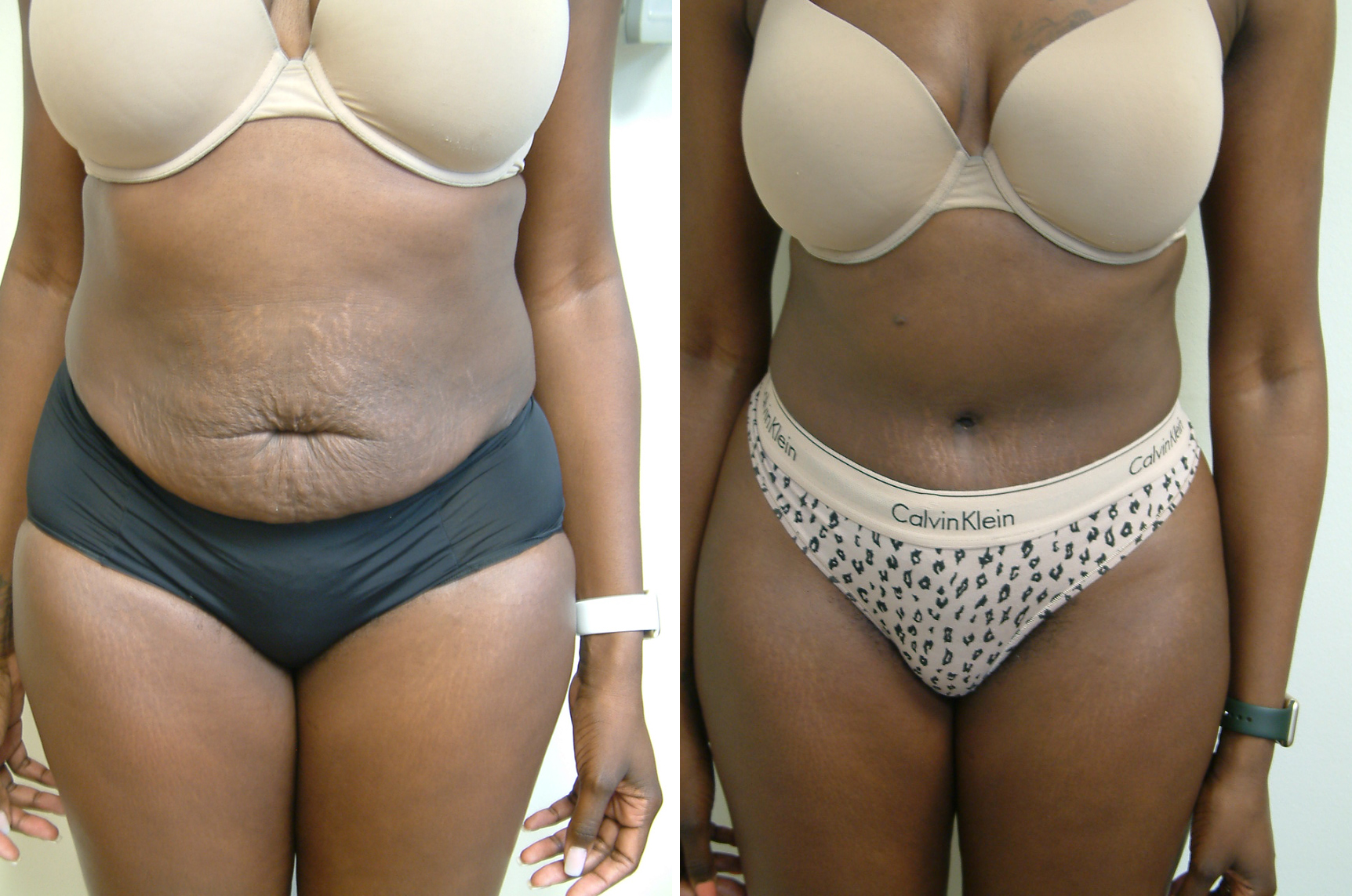 Before and After Image: Tummy Tuck - front