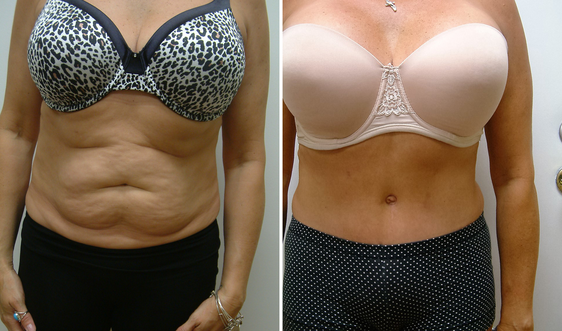 Before and After Image: Tummy Tuck - front