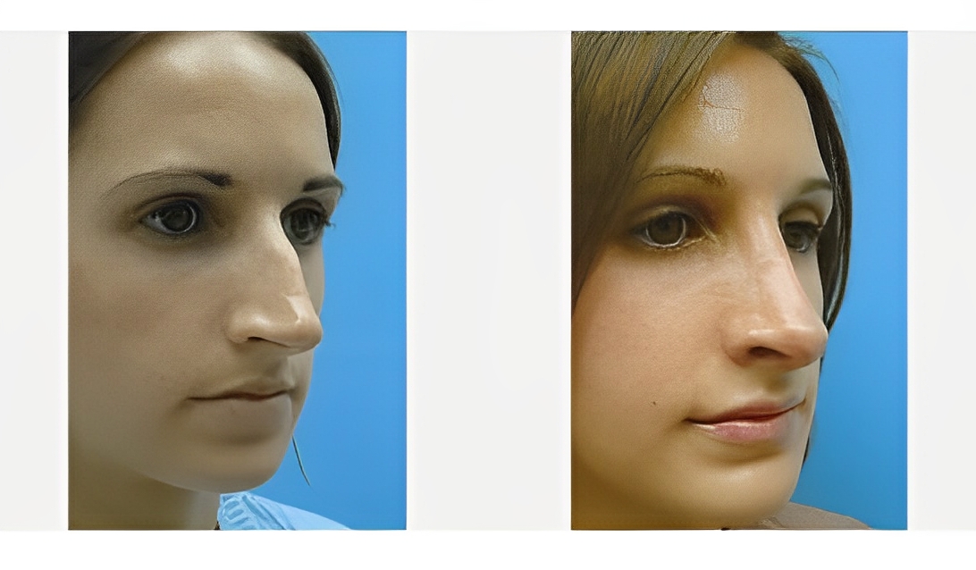 Before & After